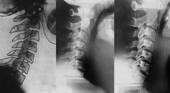 Collo con spostamento della prima vertebra cervicale