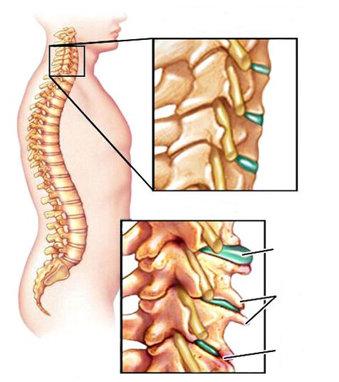 Come appare l'osteocondosi